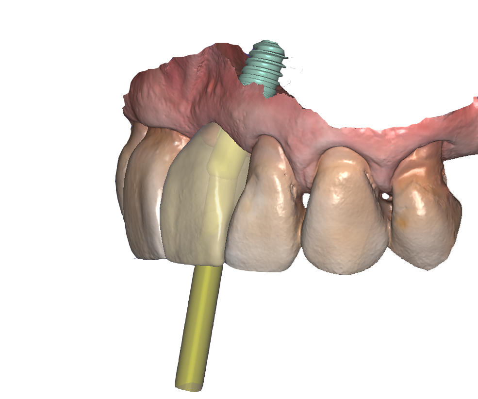 Hochästhetische Implantatversorgungen