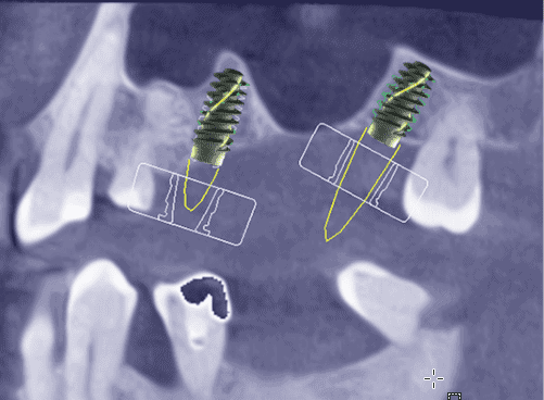 Implantatplanung Bohrschiene